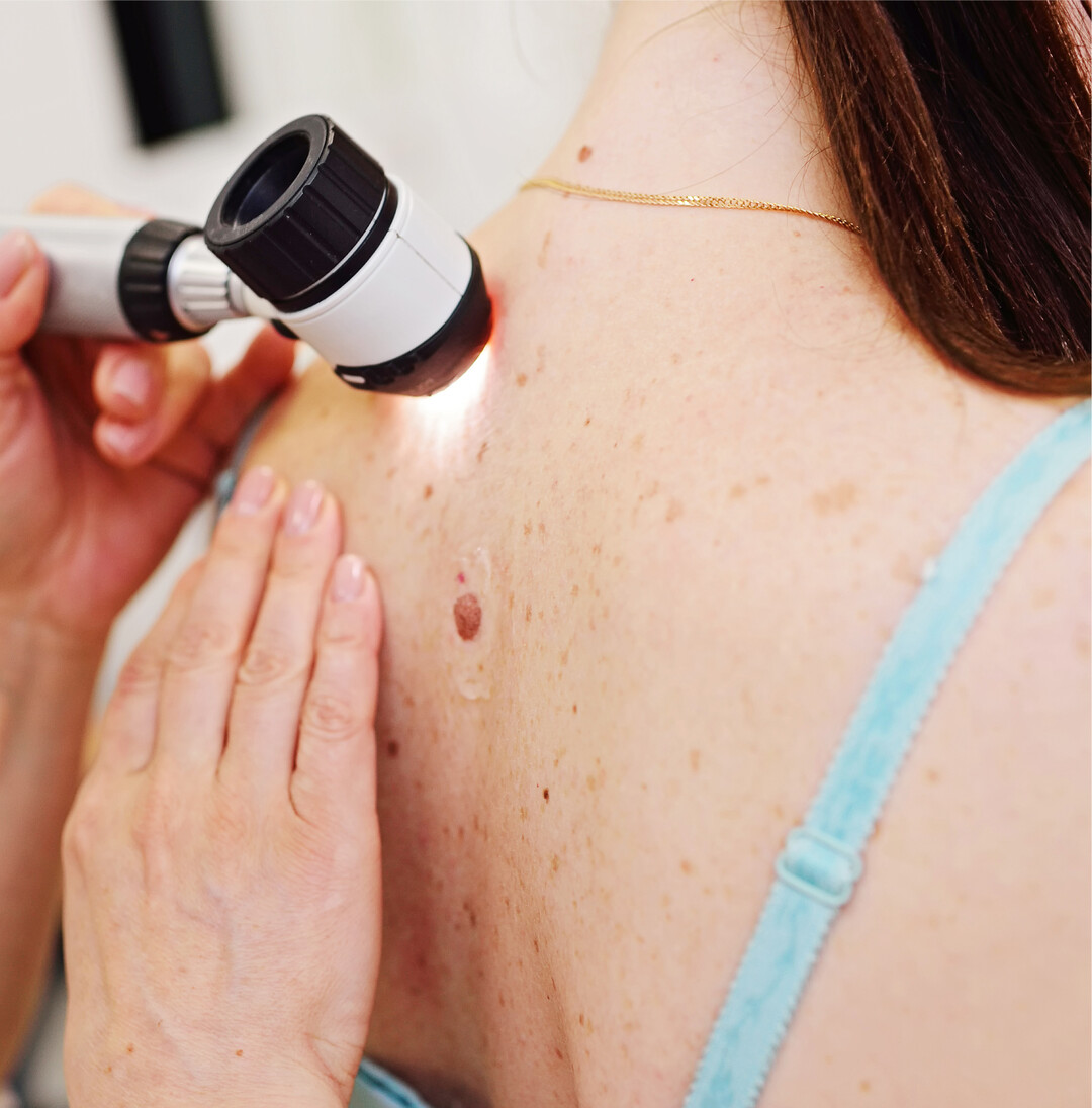 Mehr Hautkrebspatienten In den vergangenen 20 Jahren hat die Zahl der Krankenhausbehandlungen wegen Hautkrebs fast stetig zugenommen. 105.700 Menschen wurden 2021 mit der Diagnose Hautkrebs im Krankenhaus station�r behandelt. Das waren knapp 75 Prozent mehr F�lle als im Jahr 2001, wie das Statistische Bundesamt mitteilt. Zugenommen haben vor allem die Behandlungsf�lle aufgrund des sogenannten hellen Hautkrebses. Sie haben sich in den letzten 20 Jahren mit 82.100 F�llen mehr als verdoppelt. Die Zahl der Betroffenen, die wegen des sogenannten schwarzen Hautkrebses 2021 station�r behandelt werden mussten, erh�hte sich im Vergleich zu 2001 um sieben Prozent auf 23.700 Patienten. Vor allem heller Hautkrebs steht in Verdacht, durch Sonnenlicht mitausgel�st zu werden. Hautkrebs war bei 7,4 Prozent aller station�ren Krebsbehandlungen im Jahr 2021 die Hauptdiagnose. 20 Jahre zuvor lag der Anteil noch bei 3,8 Prozent. M�nner sind dabei etwas h�ufiger betroffen als Frauen. An Hautkrebs starben im Jahr 2021 etwa 4100 Menschen. Das waren 55 Prozent mehr als im Jahr 2001 mit gut 2600 solcher Todesf�lle. Im selben Zeitraum ist die Zahl der Todesf�lle wegen Krebserkrankungen insgesamt lediglich um zehn Prozent gestiegen.