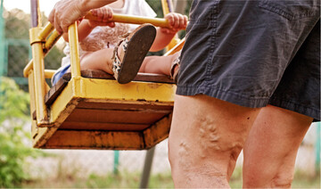 Krampfadern sind die h�ufigste Form von Venenschw�che.